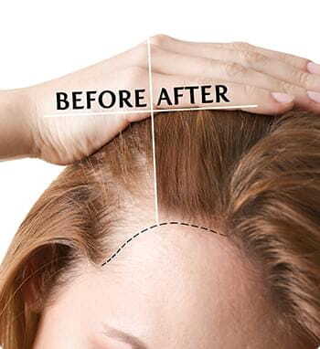 Tressanew before and after